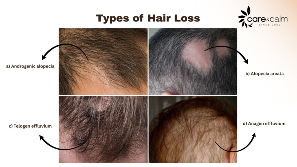 Hair Loss 