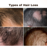 Hair Loss